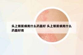 頭上銀屑病用什么藥最好 頭上銀屑病用什么藥最好用