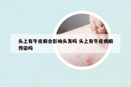 頭上有牛皮癬會影響頭發(fā)嗎 頭上有牛皮病癬傳染嗎