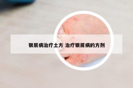 銀屑病治療土方 治療銀屑病的方劑