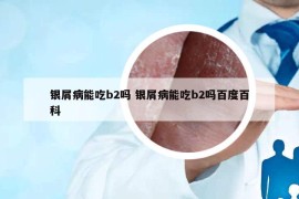銀屑病能吃b2嗎 銀屑病能吃b2嗎百度百科