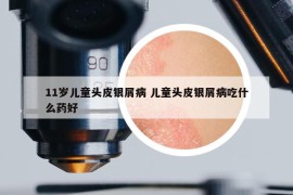 11歲兒童頭皮銀屑病 兒童頭皮銀屑病吃什么藥好
