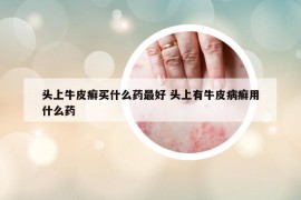 頭上牛皮癬買什么藥最好 頭上有牛皮病癬用什么藥