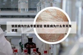 銀屑病為什么冬重夏輕 銀屑病為什么冬天發(fā)病重