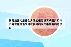 銀霄病圖片用什么方法能根治銀霄病圖片用什么方法能根治又可以很好的治療牛皮癬的方法嗎