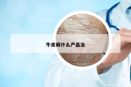 牛皮癬什么產(chǎn)品治