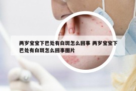 兩歲寶寶下巴處有白斑怎么回事 兩歲寶寶下巴處有白斑怎么回事圖片