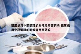 銀屑病用中藥調(diào)理的時(shí)候能用西藥嗎 銀屑病用中藥調(diào)理的時(shí)候能用西藥嗎