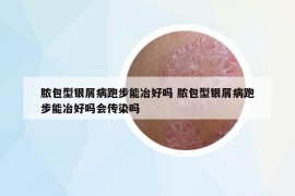 膿包型銀屑病跑步能冶好嗎 膿包型銀屑病跑步能冶好嗎會傳染嗎