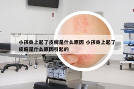 小孩身上起了皮癬是什么原因 小孩身上起了皮癬是什么原因引起的