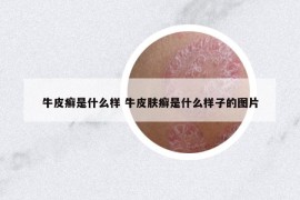 牛皮癬是什么樣 牛皮膚癬是什么樣子的圖片