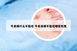 牛皮癬什么不能吃 牛皮皮癬不能吃哪些東西
