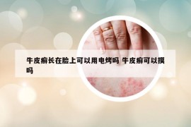 牛皮癬長在臉上可以用電烤嗎 牛皮癬可以摸嗎