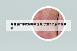 九臺(tái)治療牛皮癬哪家醫(yī)院比較好 九臺(tái)市皮膚科