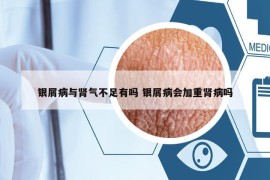 銀屑病與腎氣不足有嗎 銀屑病會加重腎病嗎