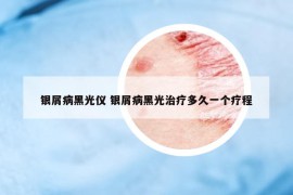 銀屑病黑光儀 銀屑病黑光治療多久一個療程