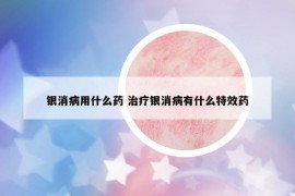 銀消病用什么藥 治療銀消病有什么特效藥