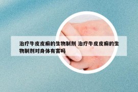 治療牛皮皮癬的生物制劑 治療牛皮皮癬的生物制劑對身體有害嗎