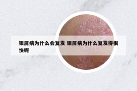 銀屑病為什么會復發(fā) 銀屑病為什么復發(fā)得很快呢