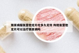 銀屑病服氯雷他定片吃多久見(jiàn)效 枸地氯雷他定片可以治療銀屑病嗎