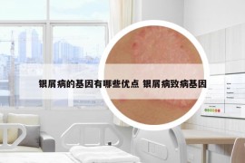 銀屑病的基因有哪些優(yōu)點(diǎn) 銀屑病致病基因