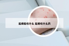 起癬能吃什么 起癬吃什么藥