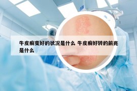 牛皮癬變好的狀況是什么 牛皮癬好轉(zhuǎn)的前兆是什么