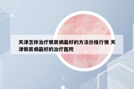 天津怎樣治療銀屑病最好的方法價格行情 天津銀屑病最好的治療醫(yī)院