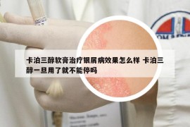 卡泊三醇軟膏治療銀屑病效果怎么樣 卡泊三醇一旦用了就不能停嗎
