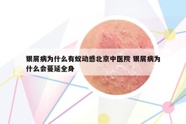 銀屑病為什么有蟻動感北京中醫(yī)院 銀屑病為什么會蔓延全身