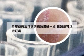 用那些藥治療銀消病效果好一點 銀消病可以治好嗎