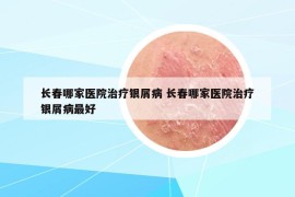 長(zhǎng)春哪家醫(yī)院治療銀屑病 長(zhǎng)春哪家醫(yī)院治療銀屑病最好