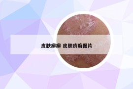 皮膚癬癬 皮膚疥癬圖片
