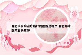 合肥頭皮癬治療最好的醫(yī)院是哪個(gè) 合肥哪家醫(yī)院看頭皮好