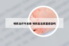 明礬治療牛皮癬 明礬能治真菌感染嗎