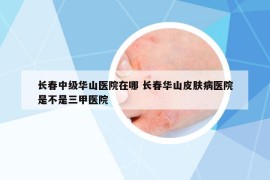 長春中級華山醫(yī)院在哪 長春華山皮膚病醫(yī)院是不是三甲醫(yī)院