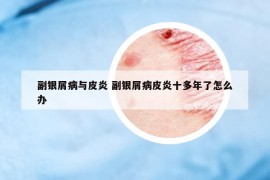 副銀屑病與皮炎 副銀屑病皮炎十多年了怎么辦