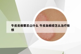 牛皮皮癬要忌口什么 牛皮血癬癥怎么治療除根