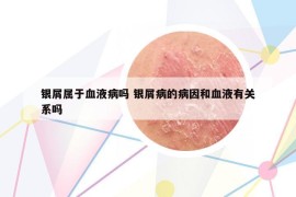 銀屑屬于血液病嗎 銀屑病的病因和血液有關(guān)系嗎