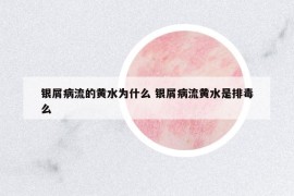 銀屑病流的黃水為什么 銀屑病流黃水是排毒么