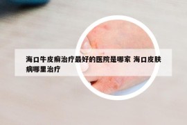 ?？谂Ｆぐ_治療最好的醫(yī)院是哪家 海口皮膚病哪里治療