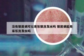沒有銀屑病可以用樂銀洗發(fā)水嗎 銀屑病能用采樂洗發(fā)水嗎