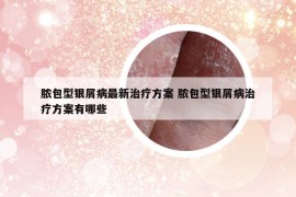 膿包型銀屑病最新治療方案 膿包型銀屑病治療方案有哪些