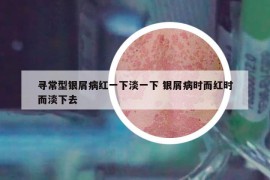 尋常型銀屑病紅一下淡一下 銀屑病時(shí)而紅時(shí)而淡下去