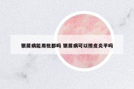 銀屑病能用枇都嗎 銀屑病可以擦皮炎平嗎