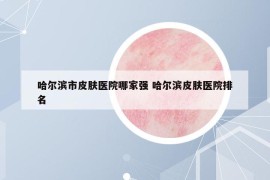 哈爾濱市皮膚醫(yī)院哪家強(qiáng) 哈爾濱皮膚醫(yī)院排名