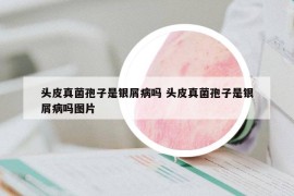 頭皮真菌孢子是銀屑病嗎 頭皮真菌孢子是銀屑病嗎圖片
