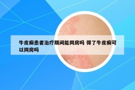 牛皮癬患者治療期間能同房嗎 得了牛皮癬可以同房嗎