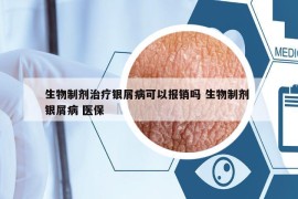 生物制劑治療銀屑病可以報(bào)銷嗎 生物制劑 銀屑病 醫(yī)保