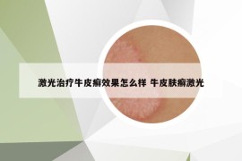 激光治療牛皮癬效果怎么樣 牛皮膚癬激光