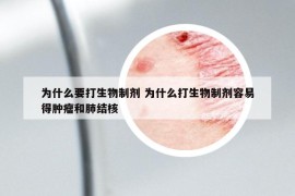 為什么要打生物制劑 為什么打生物制劑容易得腫瘤和肺結核